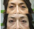 CONTORNO DE OJOS