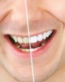 BLANQUEAMIENTO DENTAL
